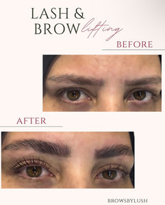 Brow lift